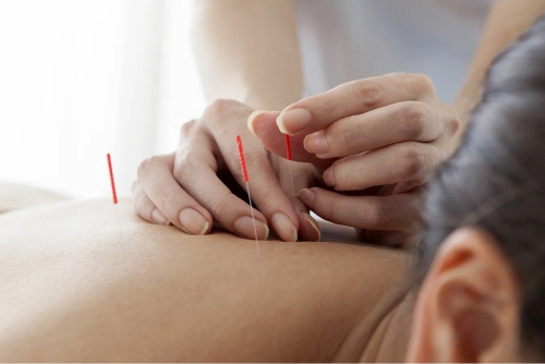 Иглоукалывание
